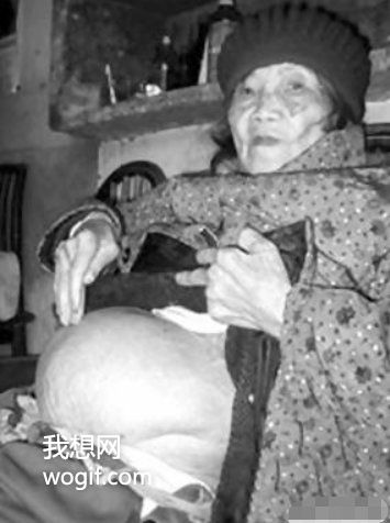 四川一91歲老奶奶不慎摔倒，到醫(yī)院后發(fā)現(xiàn)懷孕了（60年前懷上的）