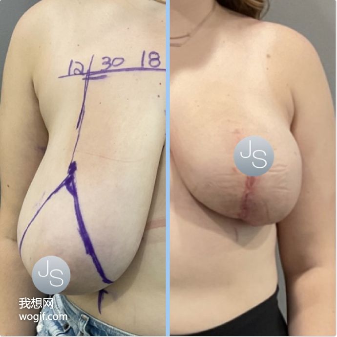 乳房縮小切口，生孩子的女生都想做手術(shù)（有圖）